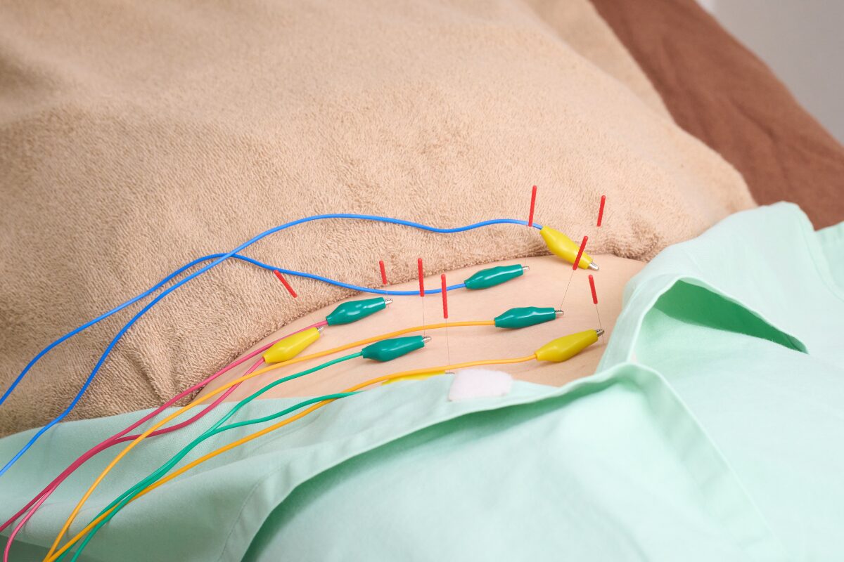 ダブルコースの鍼灸施術