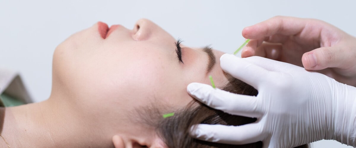 美容鍼の施術風景