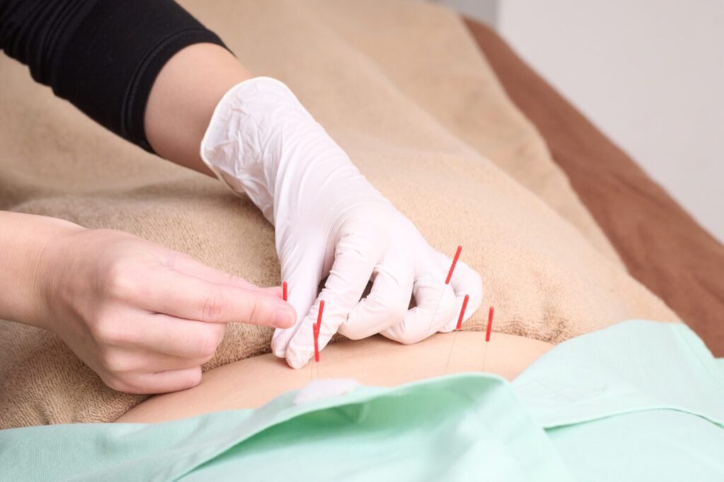腰に鍼を打つ手元
