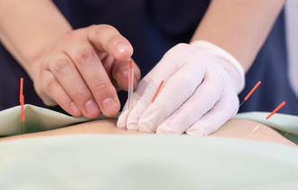 スタンダードコースの鍼灸施術